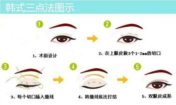 刚刚重医杨伯伯说可以刷 但是我要开眼角 重医好贵