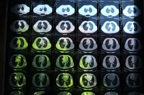 患者求诊结核球炎性假瘤肿瘤