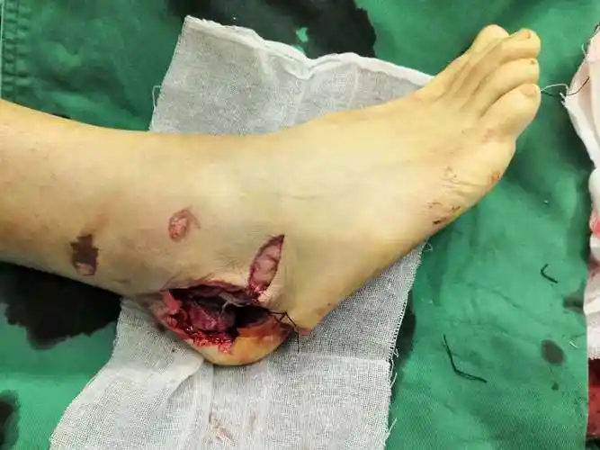 右足跟部骨质及组织缺损 皮瓣手术后恢复良好