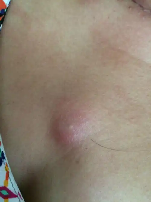 请问这个是什么,胸口长的,越来越大了,而且现在又疼