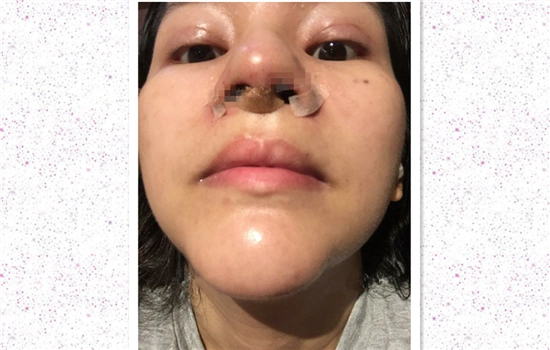 鼻头鼻翼缩小恢复日记真人记录术后一个月恢复状况