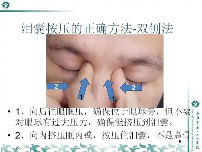 滴眼药水后的按压泪囊法_眼部疾病_眼部疾病相关疾病 - 好大夫在线