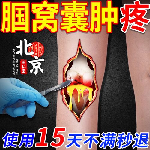 贴腿窝筋疼膝盖后窝疼鼓包肿胀抽筋伸不开蹲不下去关节积液穴位压力贴