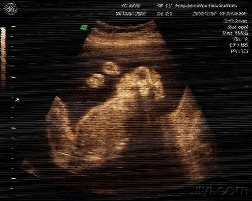 无脑儿 - 超声医学讨论版 - 爱爱医医学论坛