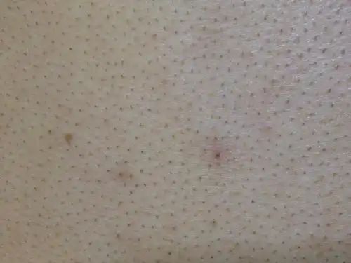 慎点,背上皮肤这样是什么情况?好恐怖