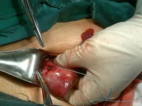 中国基层妇科诊所技术有待提高!子宫穿孔,肠穿孔.