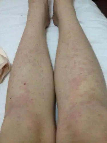 过敏全身起疙瘩怎么办?手上涂了药膏都好了点,脚上涂了越来越多