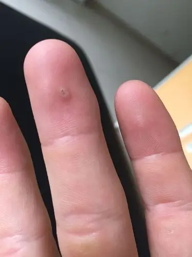 现在暂时没发现不痒不痛.该怎么办?怎么处理?