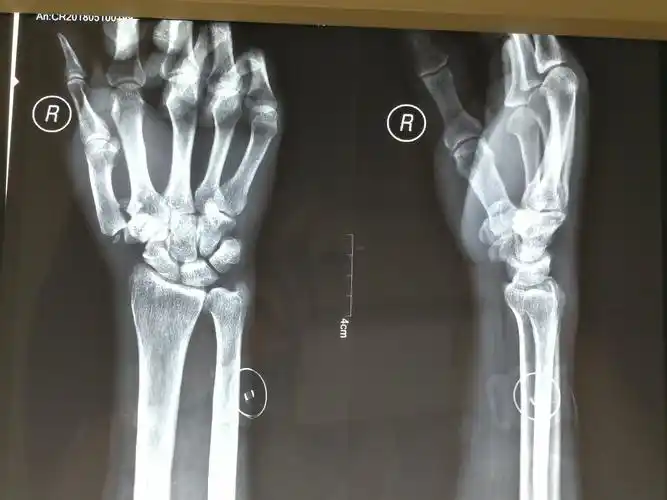 本耐氏bennett骨折即第一掌骨基底部骨折伴脱位