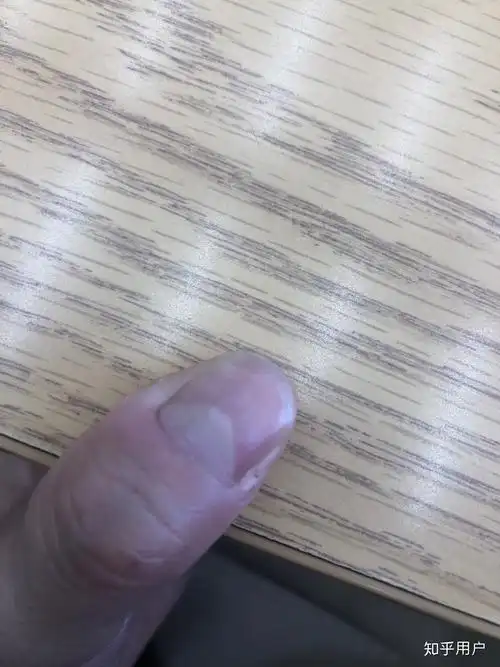 大拇指指甲凹凸不平,有凸起的横纹和凹陷,很多年了也没有其它问题,去