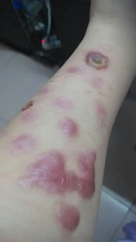 自己拿烟烫的,好玩吗…女,24岁