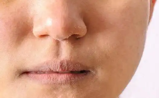 冬季皮肤干燥是怎么回事皮肤干燥要怎么缓解