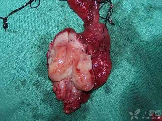 我们切掉了一个小女孩的子宫