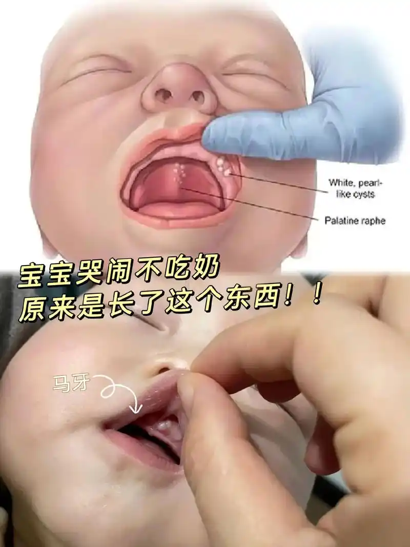 马牙,也称"板牙",医学上叫做"上皮珠",主要出现在新生儿的上颚中线和