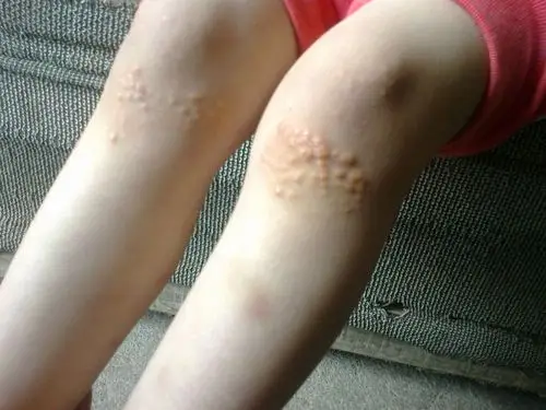 看图说话多发性脂囊瘤