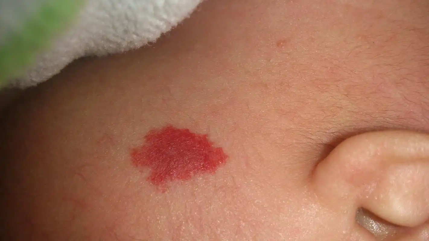 血管瘤的症状图片