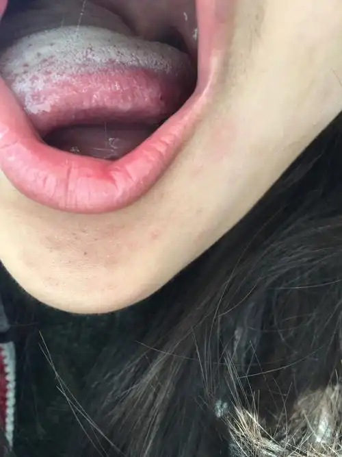 舌头上长了个黄色的东西 旁边还有红色小疙瘩 今天那个黄色的东西上面