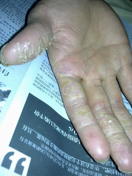 皮肤病手脱皮请教诊断和治疗