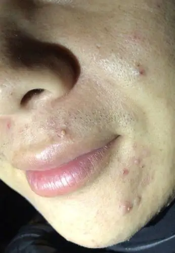 嘴唇周边为何经常长白色小包