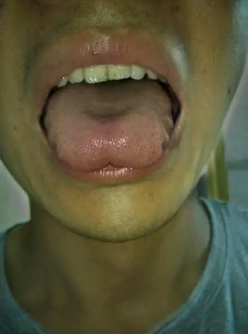 舌头上有一个痘痘,不痛不痒,有点硬,是什么原因?如何治疗?