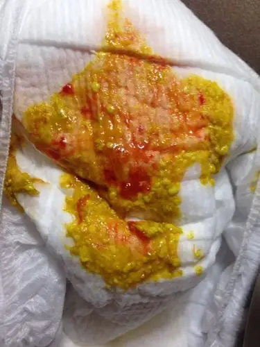 宝宝粑粑里有血丝.