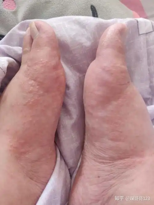 孕期长湿疹是一种怎样的体验