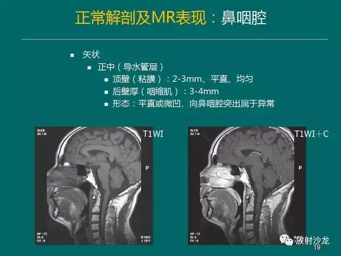 鼻咽癌的mri诊断