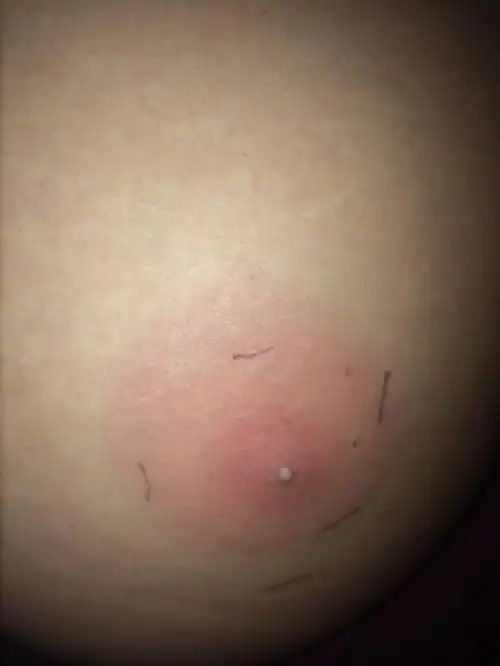 坐板疮臀部图片