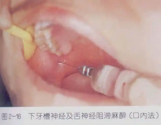 口腔麻醉方法