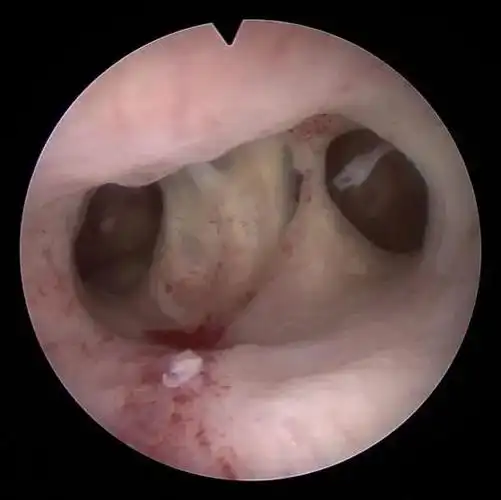 宫腔疾病不用怕文章带你了解宫腔镜手术