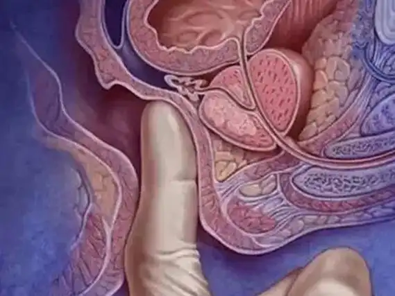 子宫脱垂一,二,三度真实图片分享,从症状可了解分级情况