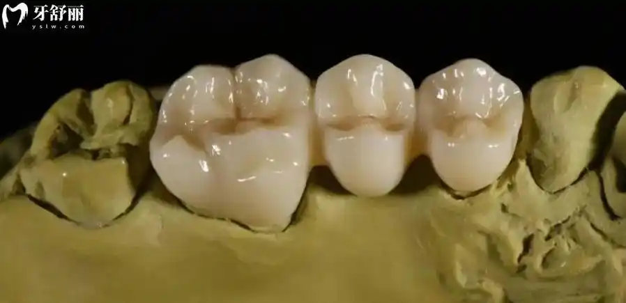 德国威兰德全瓷牙