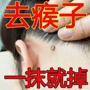 祛刺瘊子痦子去除膏去猴子脖子上长小肉粒疙瘩皮赘药肉瘤凸痣神器