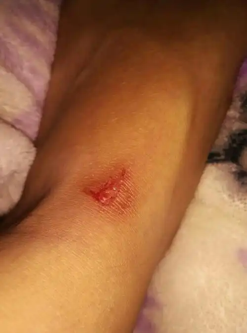 脚被玻璃刮破了,需要打破伤风吗?