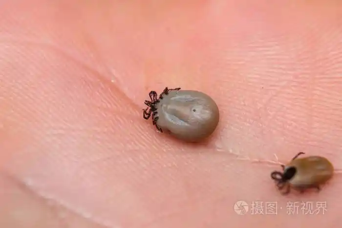 人类皮肤上的虱子