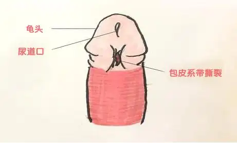 男科急诊中常见的就有包皮撕裂, 包皮系带稍微大力就可能把它撕裂