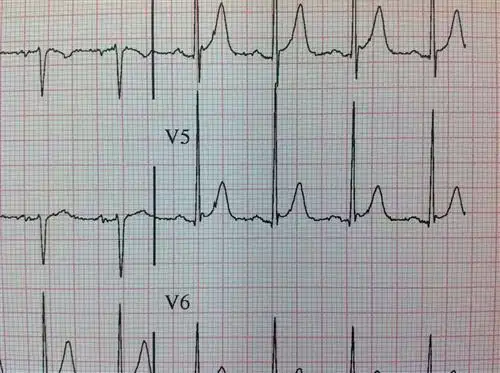 早期复极综合征