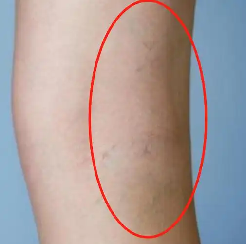 静脉曲张怎么办?7个等级自测一下!_腾讯新闻