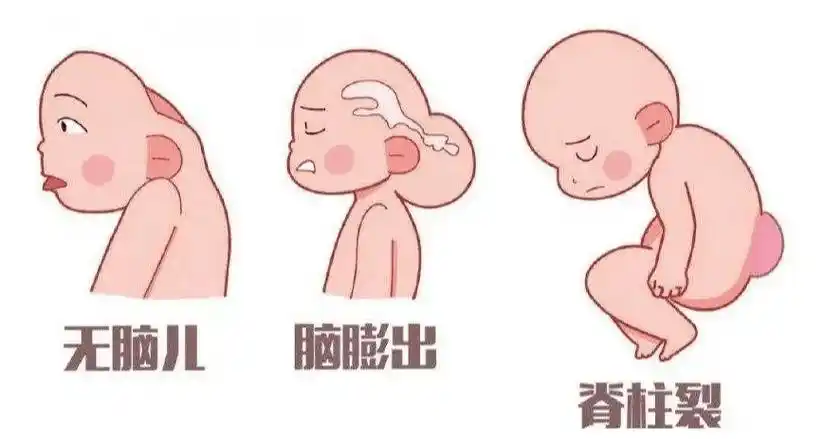 无叶型前脑无裂畸形(简称无叶全前脑),严重脑膜脑膨出等9种(2022年版