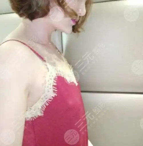 真人假体隆胸术后真实感受分享5个月照片公开