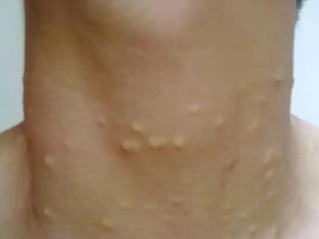 脖子上长了"小肉粒",这是为什么?或许是长了这两个东西