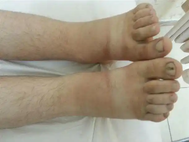 少男双下肢凹陷性肿胀1年 - 好大夫在线