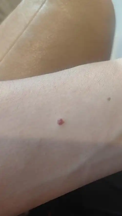 "樱桃状血管瘤"主要发生于躯干四肢,米粒大小红色球状凸起物,状似小