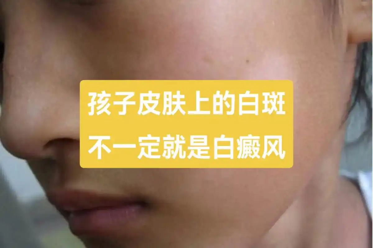 发现孩子皮肤上的白斑,往往和脾胃虚弱相关.脾胃消化水谷,为化 - 抖音