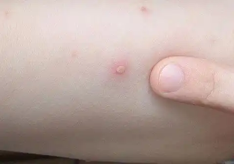 水痘第一天图片丘疹