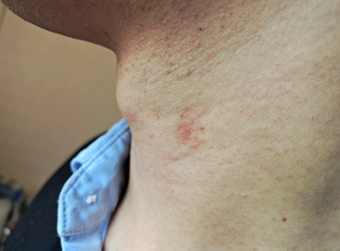 王先生:她的意思就是这是一个"草莓印"(吻痕).