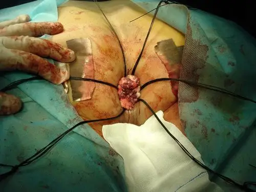 环状混合痔手术后