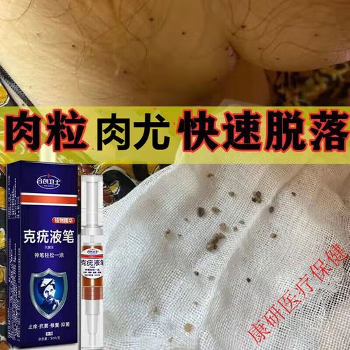 克疣笔克疣液扁平疣脸部疣瘊平除l疣立净去猴子肉粒去刺猴丝状疣脖子