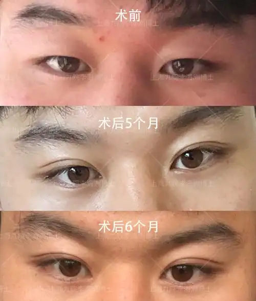 全切双眼皮案例—男生做双眼皮是什么体验?