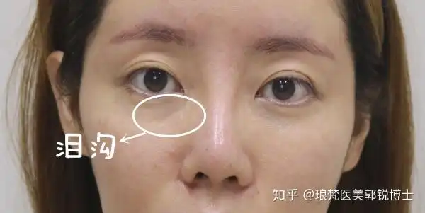 自体脂肪填充泪沟会不会形成眼袋